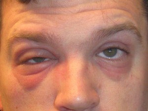 Day 7 After Biting Cashew Nut Shell Day 7 After Biting Cashew Nut Shell